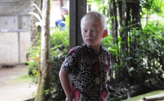 Albinizmli bireyler, dünya genelinde insan hakları ihlallerine maruz kalıyor